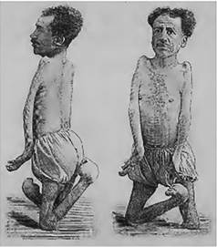 Nanomelus brachychirus, campylochirus, campyloscelus. Plácido Rocha, 46 años de edad. Manos torcidas, pies torcidos; ankylosis de las articulaciones de los hombros, de los codos y de las rodillas