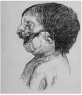 Labio leporino geniano. Macrostoma