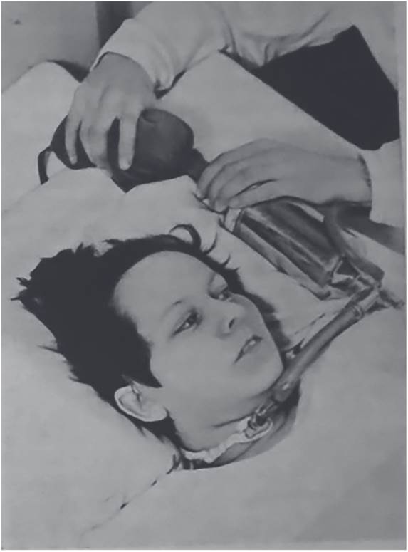 Pulmón de acero tipo drinker machine